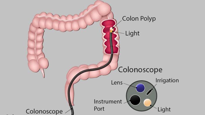 মলাশয়-মলদ্বারের ক্যানসার শনাক্তে কোলোনস্কপি